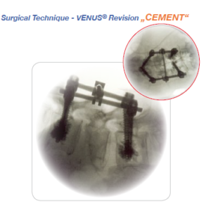 Venus 6T Cement